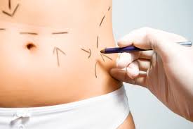 Resultado de imagem para abdominoplastia free