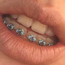 Black And Baby Blue Braces Braces Braces Colors Braces Colors Cute Braces Colors Cute Braces