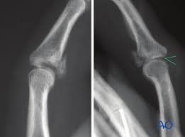 Finger pip extension immobilization splint, type 0 (1) in the form of cylinder casts or gutter splints are used frequently as protection splints for proximal phalanx fractures. Volar Plate Arthroplasty For Proximal Volar Plate Avulsion
