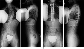 Surgery | Scoliosis Research Society