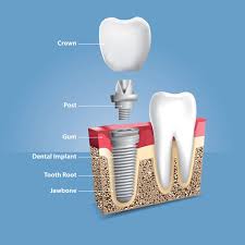 Image result for dental implant