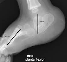 No specific contraindications for surgery exist… Orthokids Vertical Talus