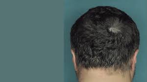 Drug Restores Hair Growth In Patients With Alopecia Areata Youtube