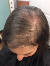 Here is a look at the most common cause of hair loss in teens. How To Identify Early Signs Of Hair Thinning Hairoots Hair Restoration Treatment Center