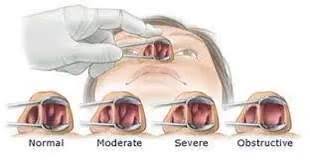 Coronal section showing soft tissue windows rather than bony windows. Homeopathy Nasal Polyps Causes Of Dr Haseeb Ahsan Homeoepathic Physician Beauty Care