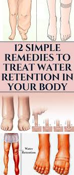 12 Simple Remedies To Treat Water Retention In Your Body Remedies Healing Health Waterretention Water Retention Remedies Body Health Water Retention