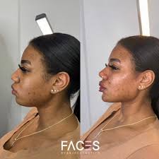 Best Facial Balancing in Nyc