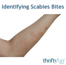 Image result for scabies human bites