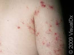 Image result for scabies human bites