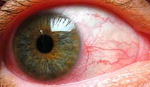 Como Quitar Las Venitas Rojas De Los Ojos