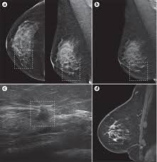 On the mammogram, there is a tumor with secondary skin retraction. Breast Cancer Nature Reviews Disease Primers