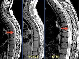 Krankheitsschübe wie auch läsionen in der magnetresonanztomographie (mrt) reflektieren den krankheitsprozess bei der… teriflunomid reduziert den jährlichen verlust an hirnvolumen frankfurt, 02. The Radiology Assistant Myelopathy