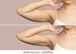 Dearest Lou: Before And After: Arms | Fitnesstips, Fitness, Lou