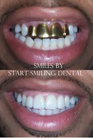 The tooth crown fitted perfectly from the start. Pin By Start Smiling Dental On Porcelain Crowns Porcelain Crowns Dental Crowns Dental Bonding
