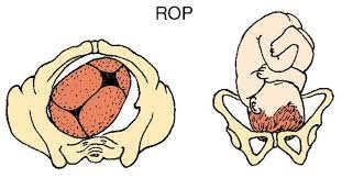 Image result for Manual Rotation in Occipitoposterior Presentation