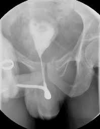 Image result for Retrograde Urethrogram