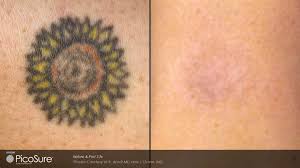 Amazing Results From Picosure Laser For Tattooremoval Maybe It S A Lifestyle Change Ma Natural Tattoo Removal Tattoo Removal Cost At Home Tattoo Removal