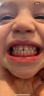 Hi! I have concerns about 2 of my sons. One is 3.5 and the other is 2. The  3.5 year old has a very narrow palette and head in general. I was