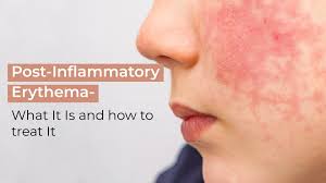 نتیجه جستجوی لغت [inflammatory] در گوگل
