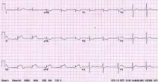 Trivia questions can jog the memory and provide an opportunity to take a little. Ecg Skills Trainer Part I Proprofs Quiz