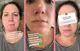 Winter Face Rash This Surprising Cause May Be Giving You Red Bumps