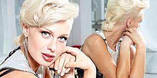 Caridee English Before And After Pictures Of Psoriasis Health Com