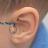 Fungal ear infection is an infection of the ear with a fungus. 1