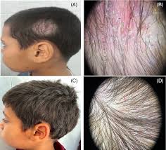Image result for Tinea Capitis
