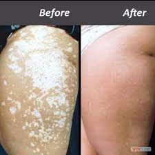 Azmiderm plus (formula original del dr. Azmiderm New Azmiderm New Added 8 New Photos To The Facebook