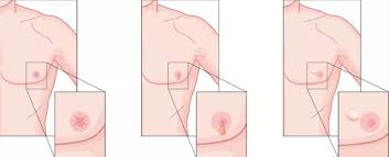 The bruised place looks red and swollen at first. Breast Cancer In Men Steemit