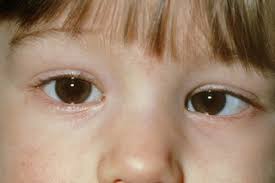 You don't need to try and remember all the signs and symptoms of cancer, but we have listed some key ones to give you an idea of the kind of things to be. Squint Nhs