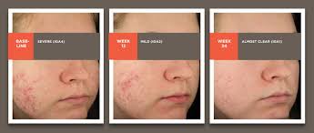 acne acne scarring and the oscar study epiduoforte