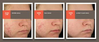 Acne Acne Scarring And The Oscar Study Epiduoforte