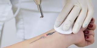 There are several techniques available to stop regrowth after. The Latest Innovations In Tattoo Removal Inside Out
