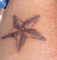 Ink eraser is a laser tattoo removal clinic that strives to be accessible, which is why we offer financing options at our multiple locations in georgia: Laser Tattoo Removal Atlanta Ga Remove Unwanted Tattoos