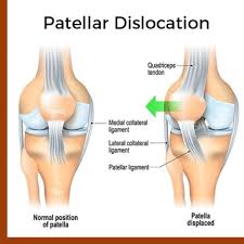 Image result for Patellar Tilt Test