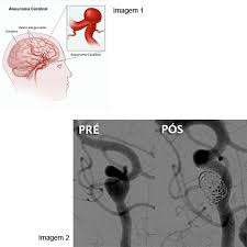 Especialistas falam sobre aneurisma cerebral. Hci Hemodinamica E Cardiologia Invasiva Ver Artigo