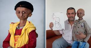 This is spanish gar 15 sec b by paul arredondo on vimeo, the home for high quality videos and the people who love them. Le Jeune Garcon Qui Souffrait De Vieillissement Accelere Meurt A L Age De 15 Ans Vonjour