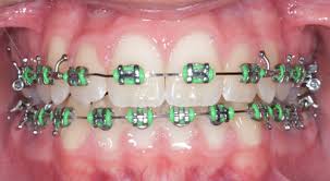Treatable cases teens, adults & little smiles invisalign cost get invisalign vivera® retainers yes, invisalign clear aligners can fix some types of crossbite. Anterior Crossbite Treatment Before And After Braces Bethlehem Pa