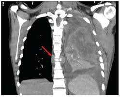 An Adolescent With Cough Congestion And Back Pain A Delayed Diagnosis Of Hodgkin Lymphoma Consultant360