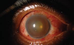 Image result for Uveitis
