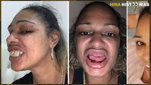 Mulher vai à Turquia tratar os dentes e volta banguela para casa. Mas o  resultado final é incrível 