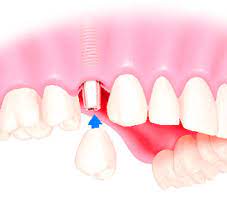 Karies Behandlung Zahnfaule Entfernen Ganz Ohne Bohren Welt