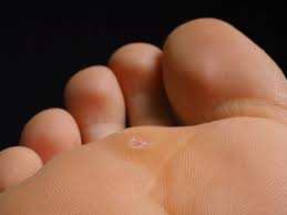 Warts which show up on the bottom or top of the feet or toes fall into the plantar wart category. Plantar Warts 101 Everything You Need To Know U S Dermatology Partners Blog