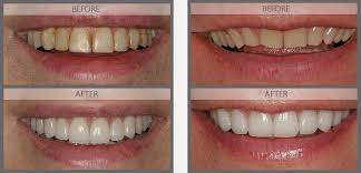 Veneers can be used to correct a wide range of dental issues, such as: Porcelain Veneers Nyc Dental Veneers Nyc