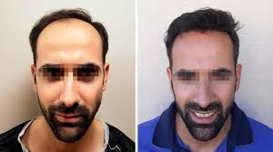 The extent of a patient's hair loss. Hair Transplant Surgery In The Uk Abroad Qunomedical
