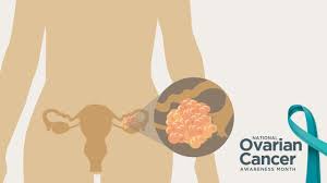Common symptoms of ovarian cancer include bloating, pelvic pain, feeling full quickly, and urinary symptoms. National Ovarian Cancer Awareness Month Right At Home In Home Care For Seniors