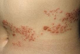 Image result for shingles