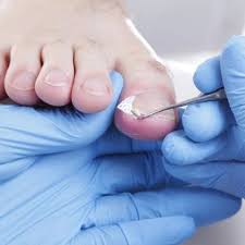 Image result for Toenail Removal