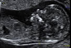Wann feindiagnostik, feindiagnostik in schwangerschaft das erwartet dich beim feinultraschall rubbelbatz de. Ersttrimester Ultraschall Fruhe Feindiagnostik Nackenfaltenmessung Praxis Fur Pranatale Diagnostik